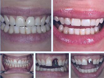 Single Tooth Implants | NYC Dental Implants | Manhattan NY